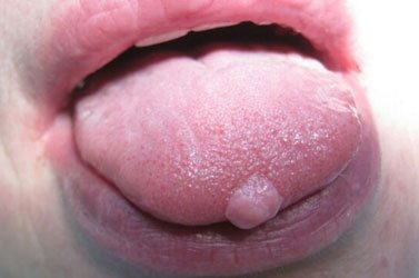 Папилломавирусная инфекция во рту